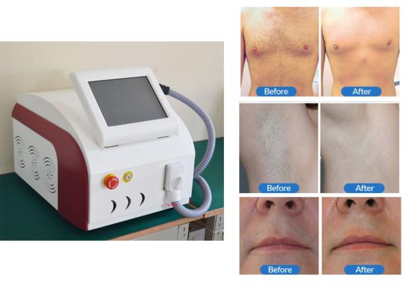 Adjustable Frequency Diode Laser Hair Removal System For Leg Rehabilitation Equipment