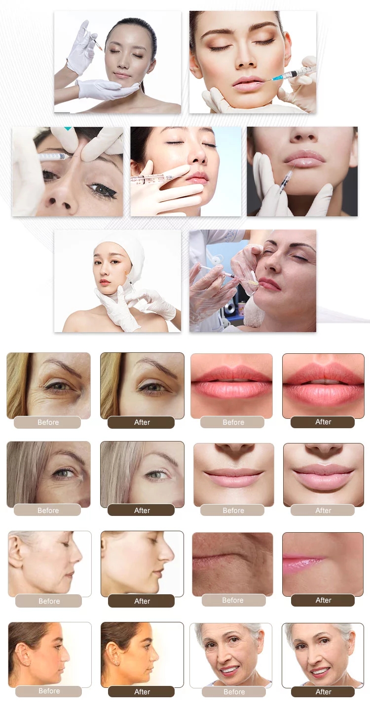 Кислота корейского геля заполнителя 1ml Neuramis дермального анти- старея Hyaluronic