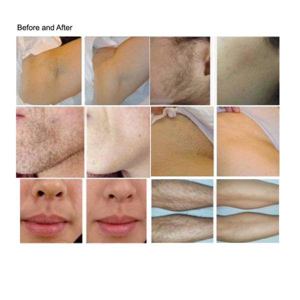 Машина удаления волос лазера диода удаления 808nm волос equipmemnt красоты продажи продвижения постоянная для продажи