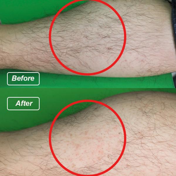 755nm and 1064nm ND Yag Can Gentle Laser Hair Removal Machine with 3-200ms Pulse Width