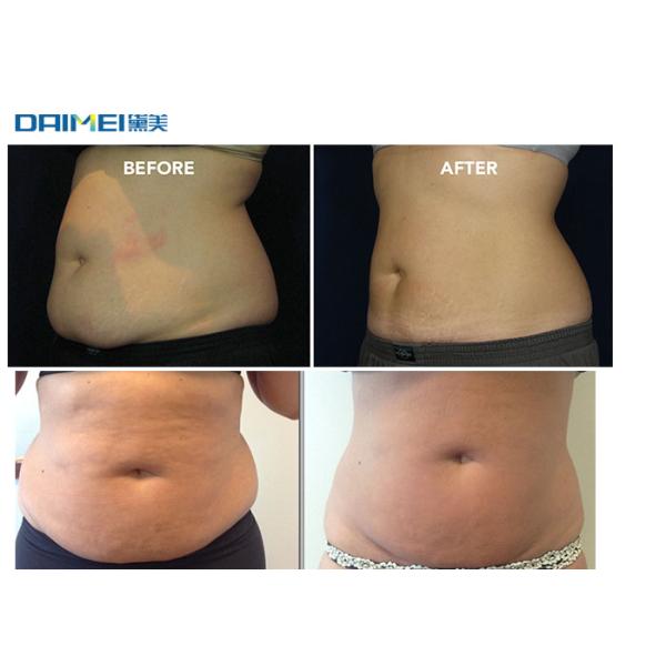 Cavitation Body Slimming Machine , Cryolipolysis Vacuum Machine For Skin Tightening