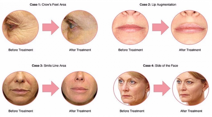Sub-Q Revolax Dermal Filler для уменьшения длительных морщин