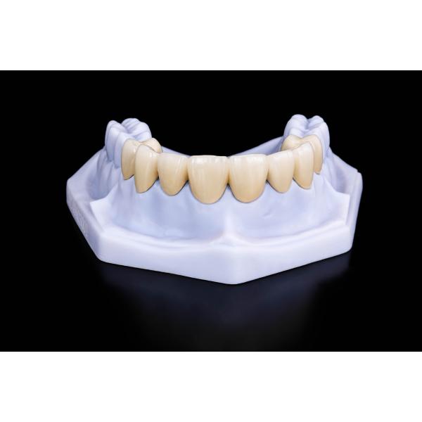 Precisely Fitting PFZ Bridge Natural Esthetics