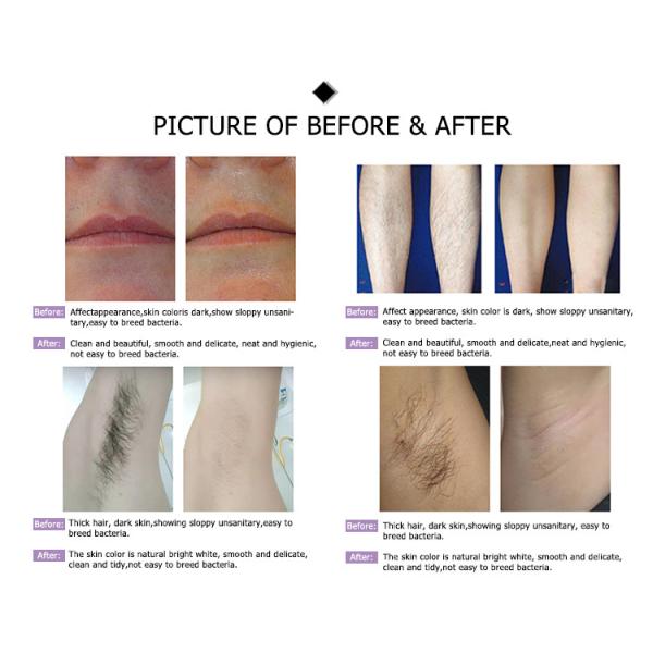 china Vertical high power new tri-wavelength depilacion equipment maquina de hair removal 810 808nm laser diodo