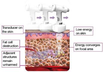 HIFU ultrasonic fat cavitation for fat loss hifu slimming machine