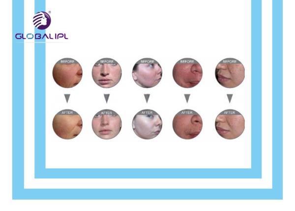 Deep Skin Cleaning Water Oxygen Jet Peel Machine Acne Removal 6MHZ Frequency