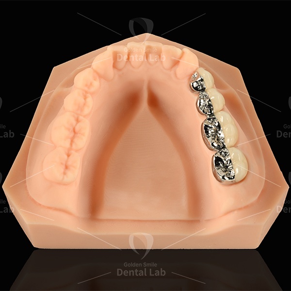 Dental PFM Bridge Lingual And Occlusal Metal Including Cusp Buccal Only Porcelain