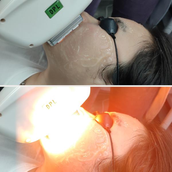 Prece Pulse IPL Therapy System SH Удаление сосудов Пигмент Удаление машины для клиники