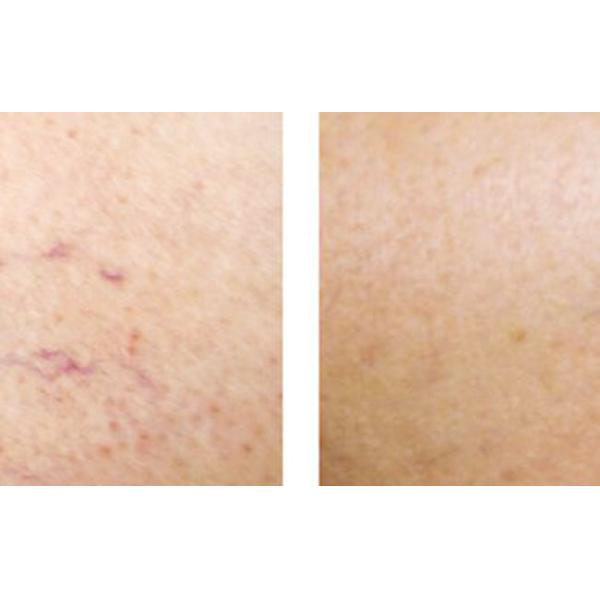 FDA Certificate 980nm Laser Spider Vein Removal Machine Vascular Therapy