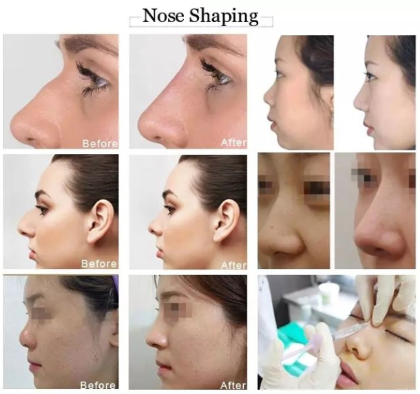 линия нос 2ml Fosyderm глубокая формируя заполнитель для лицевой пластмассы