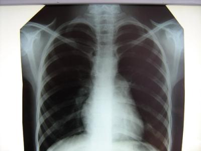 Filme 14 x 17in da impressora térmica X Ray para a impressora 5500/3000/5302/5503/5300 de AGFA