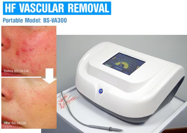 Máquina de alta frequência indolor dos cuidados com a pele 30MHz para o tratamento da veia da aranha