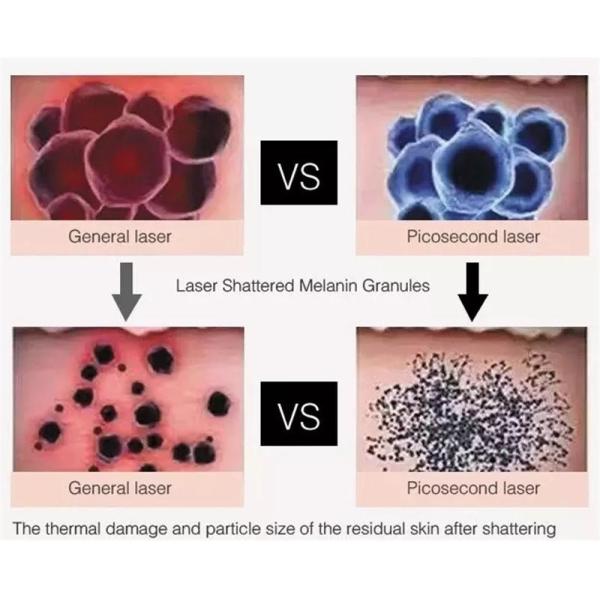 машина удаления лазера Hyperpigmentation пикосекунды лазера Nd Yag 2in1 Pico 808nm