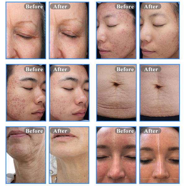 30W-200W RF Beauty Machine Scar Removal Tixel Thermal Skin Rejuvenation Machine