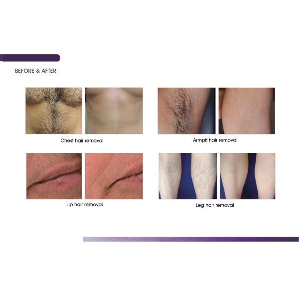 OEM Painless FAC Tech 808 Diode Laser Machine Vertical Permanent