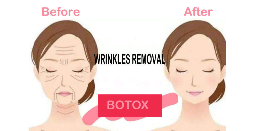 Порошок Botulax Botox 100iu белый для впрыски Botulinum токсин извлекает сморщивает
