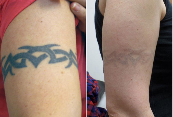 1 - 10hz Mini Size Nd Yag Laser Tattoo Removal Machine Pain Free With Multifunction