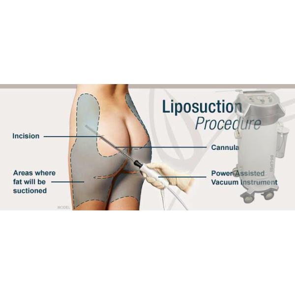 Power Assisted Liposuction Machine Intervention therapy fat suction