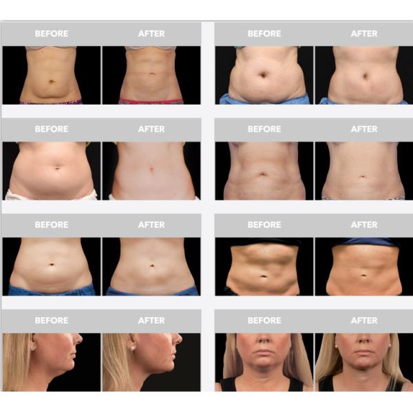 Professional Slimming Machine Cryolipolysis Coolsculptor Machine For Fat Weight Reduction 2-6 Handles for Option