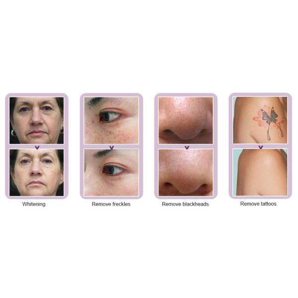 1000mj ND YAG Laser Hair Removal Machine Body Tattoo Pigments Removal Without Injury