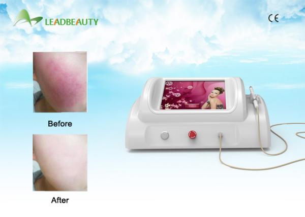 New Technology Rbs Vascular Removal / Spider Veins Removal Rbs Vascular