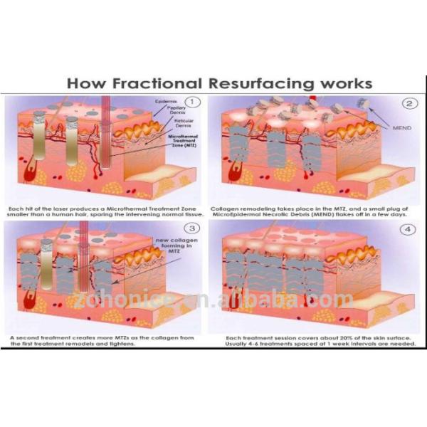 Resurfacing кожи машины резца лазера RF пробки металла 10600nm частичный