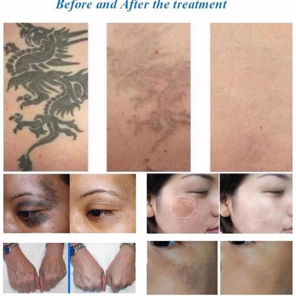 Изготовленная на заказ машина удаления татуировки лазера дома НД Яг переключателя к для всех татуировки/бровей цвета