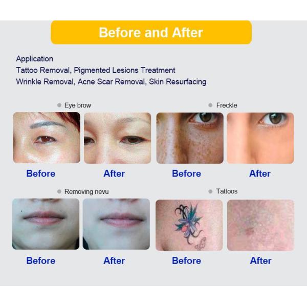 Nd Yag Picosecond Q Cambiado Nd Yag láser 2025 Picosecond láser de eliminación de tatuajes máquina de belleza láser Picosecond