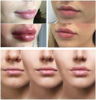 Linhas lisas/bordos gordos com enchimento injetável ácido hialurónico 1ml 2ml 5ml