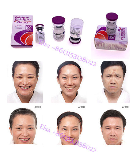 L'anti visage botulinum de la toxine 100IU ride l'injection blanche de poudre de botox d'Allergan