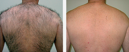 Longitud de onda permanente 1064nm/532nm de la máquina del retiro del pelo de SHR IPL aprobada por la FDA