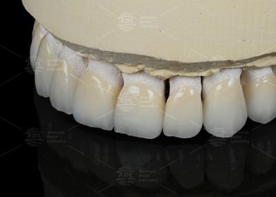 Natural Tooth Color Ceramic Feldspathic Veneer For Anterior And Posterior Teeth