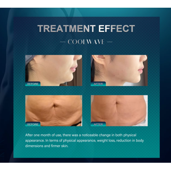 3 Handle Facial Body Tightening Skin Firming and Contour Sculpting Cryowave Shaping Machine