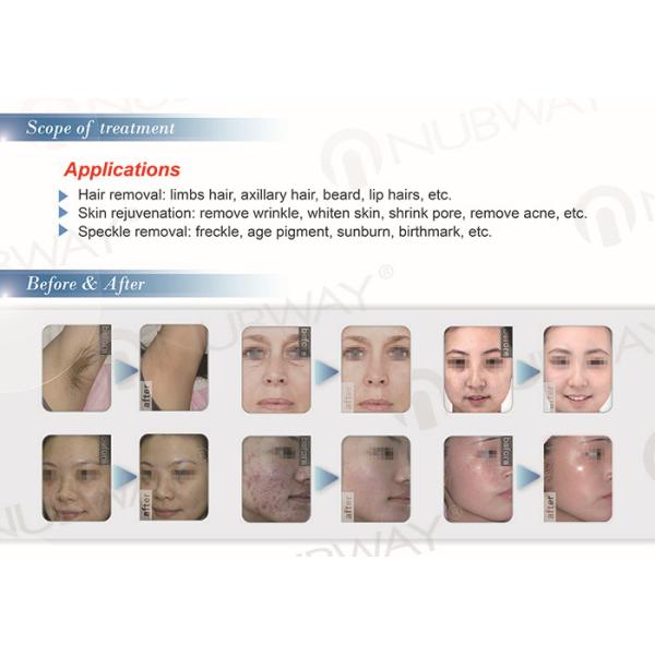 laser hair removal diode laser hair removal machine price