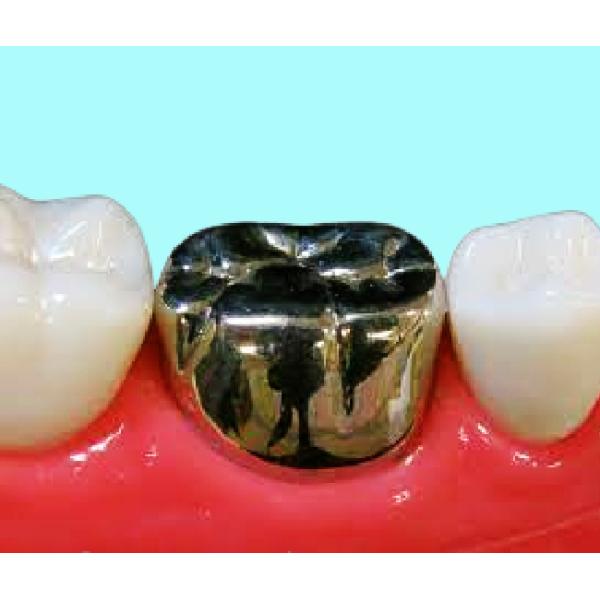 Высокое золото твердости имплантирует коррозионную устойчивость кроны драгоценного металла кроны