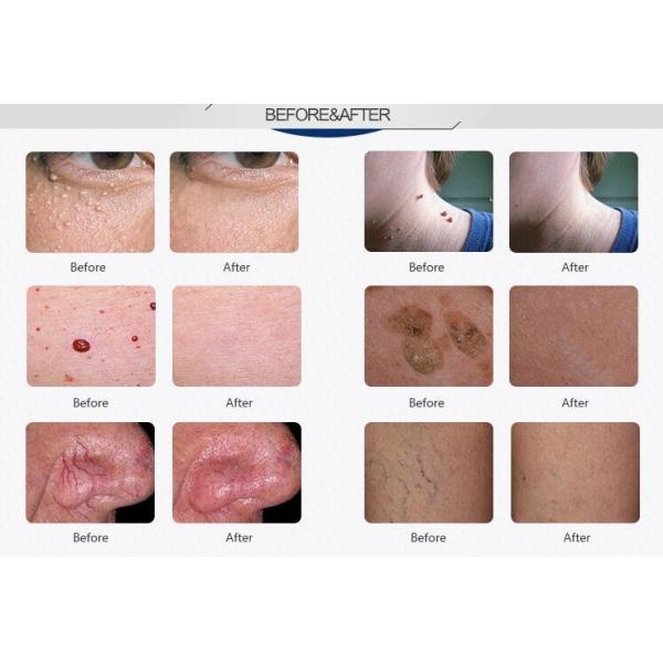 Most Effective 980nm laser Spider Vein Removal Device /high Frequency Vascular Removal/Vein Clearer