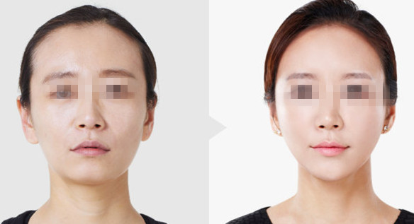 Skinject увеличение губы дермального заполнителя 2 ML Hyaluronic кисловочное лицевое заполняя