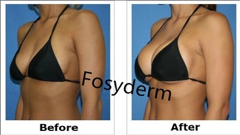 Заполнитель груди Хялуроник кислоты личной заботы 10мл для увеличения размера груди