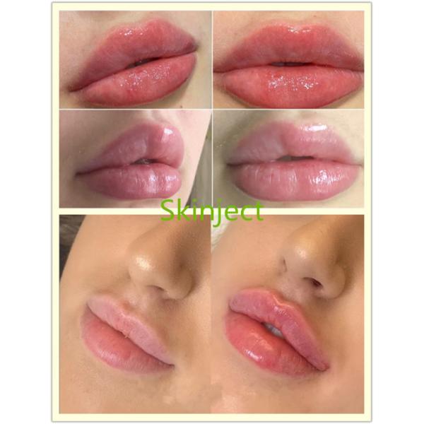 Hyaluronic кисловочный заполнитель стороны 24mg/ml ультра 3