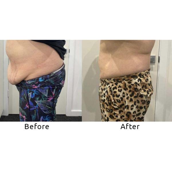 Coolwaves Cryotherapy Cool Radio Frequency Ems Muscle Stimulation Body Contouring Machine