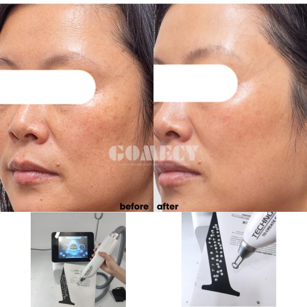 500W High Power ND YAG Laser Device for Skin Rejuvenation , Portable Solid State ND YAG Laser for Red and Brown Pigment Clearance