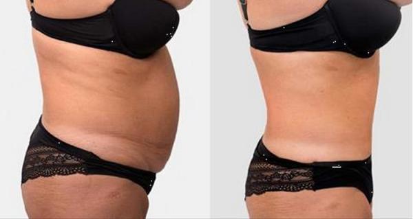 Infrared Light Vacuum RF Slimming Machine  System For Fat Burning