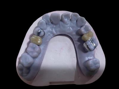 Highly Precise PFM Crown Dental Alloy Ni Free Metal Porcelain Crowns