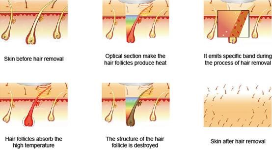depilação laser vMost advanced hair removal laser /808nm diode laser hair /pianless hair removal laser,lightsheer