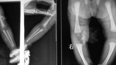 Filme seco médico de X Ray de Digitas para a impressora térmica 11in x 14in