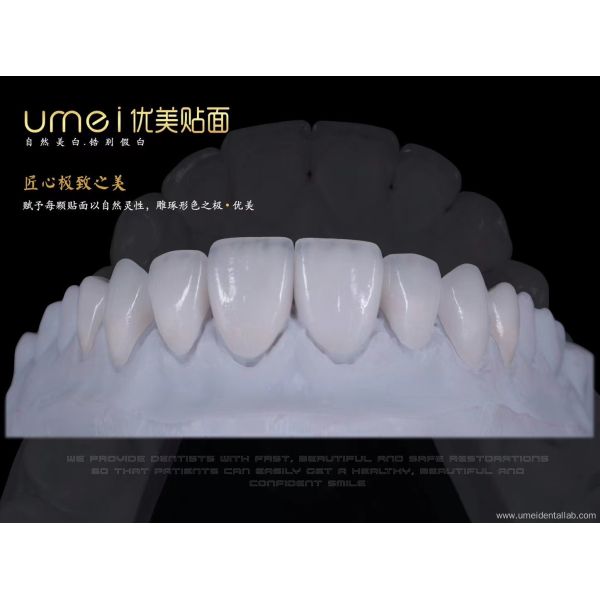 Ultra-thin aesthetic dental veneers