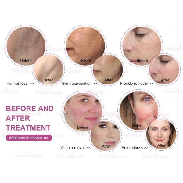 Vertical IPL Hair Removal Machine , 360 Magneto - Optic Skin Rejuvenation Device