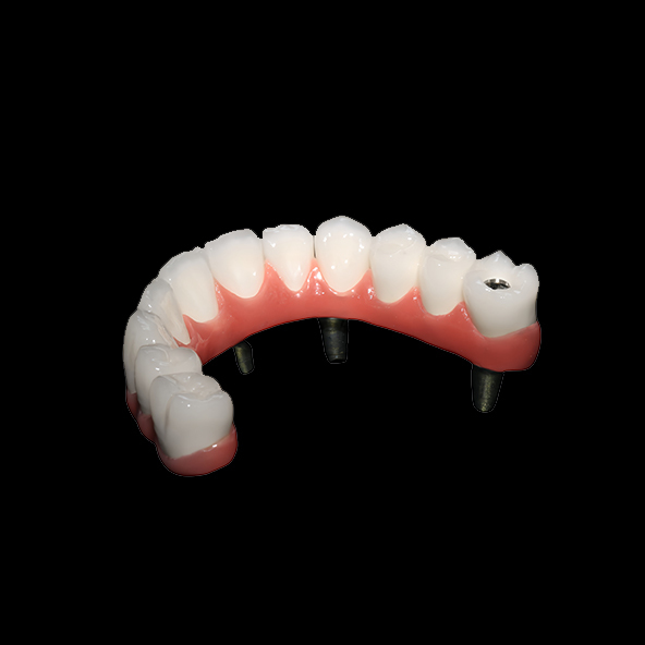 Digital Dental Solutions Lab | AOX Class I All On 4 Dental Implants Hybrid Titanium Screw Retained PFM