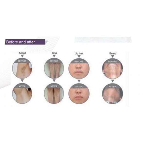 High Power 808nm Diode Laser Epilation Machine Permanent Hair Removal For Spa And Salon