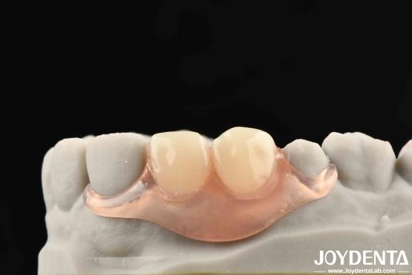 Beautiful And Harmonious Appearance Design Framework Set Up Teeth Finish Elaborate Technology For Stable Oral Structure